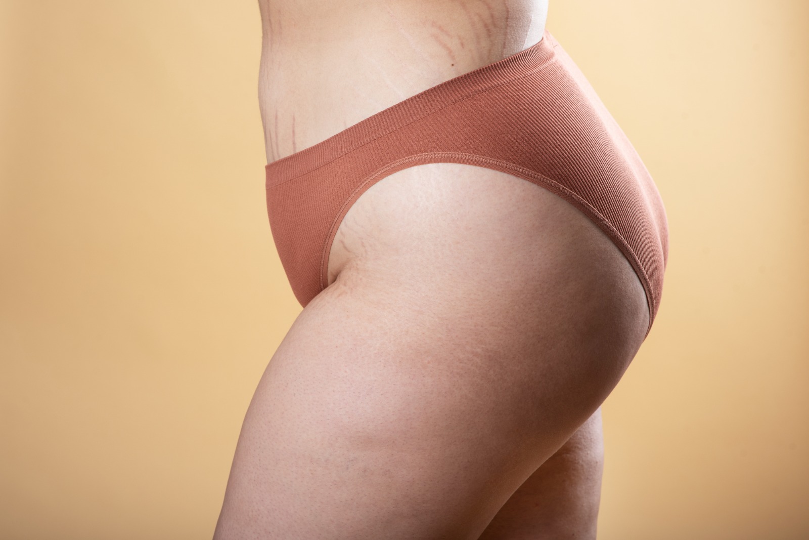 Bacaklarınızdaki Şişliğin Sebebi Ne? Lenfödem mi, Lipoödem mi?