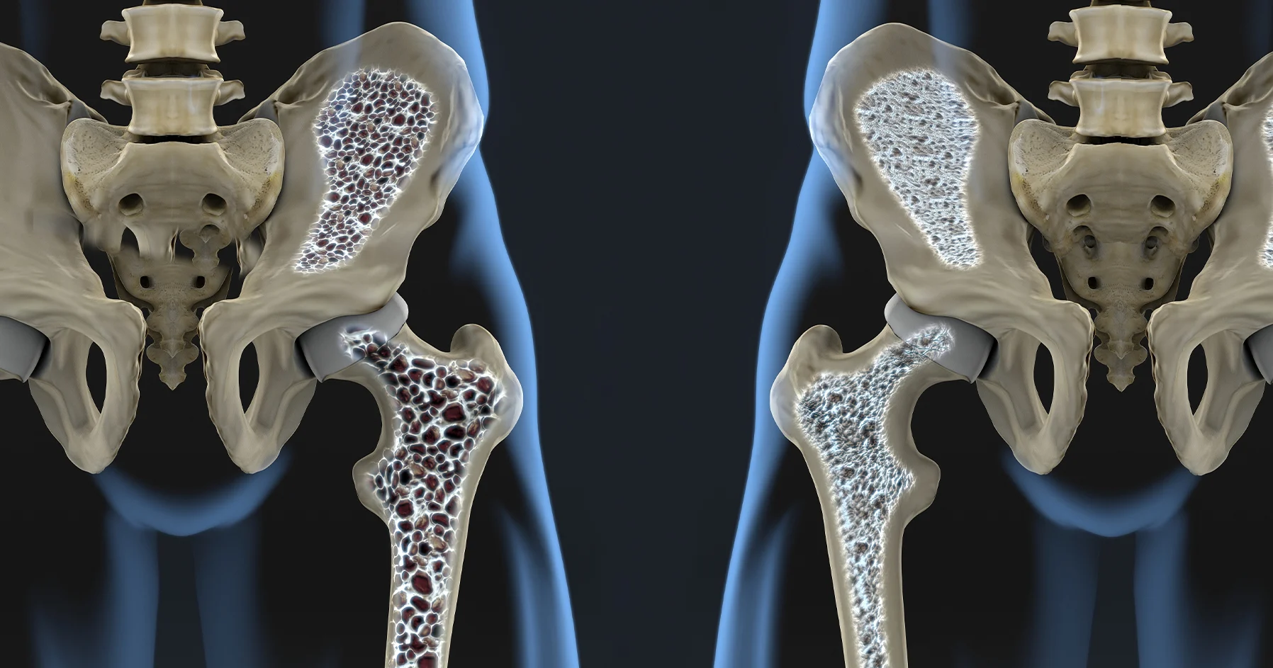 Osteoporoz